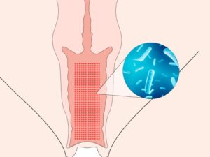 Efecto Laser Co2 Microbiota Vaginal