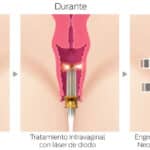 Laser Intimo Vaginal Co2 y Hifu