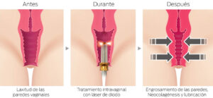 Laser co2 vaginal rejuvenecimiento Santiago