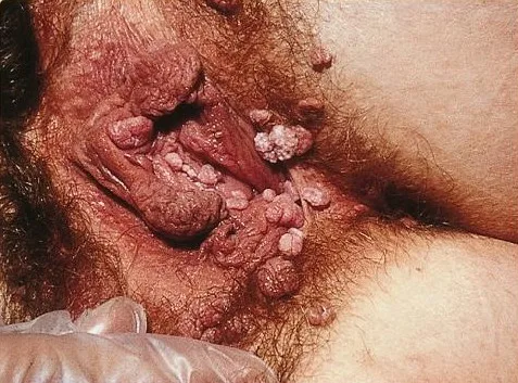 Condilomas en la vulva: verrugas genitales múltiples de superficie rugosa en la zona vulvar
