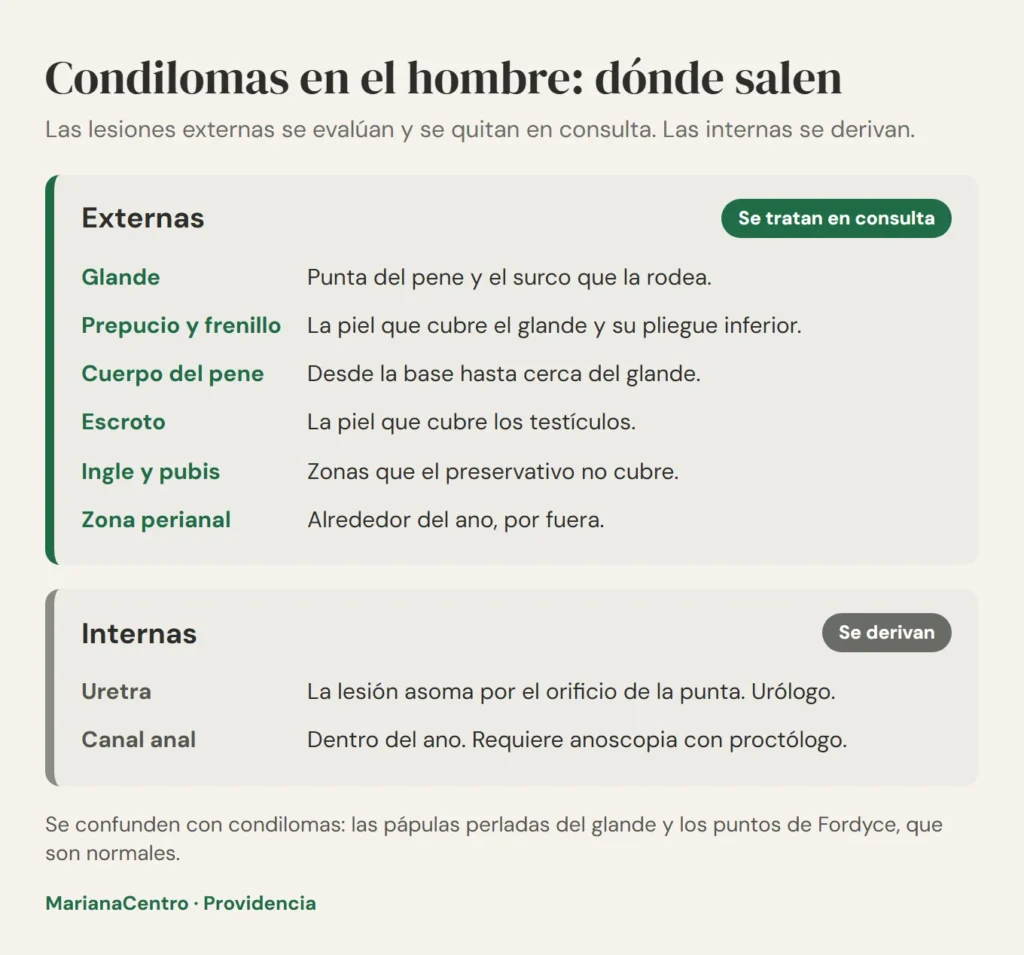 Diagrama de dónde salen los condilomas en el hombre: lesiones externas en glande, prepucio, cuerpo del pene, escroto, ingle y zona perianal, y lesiones internas en uretra y canal anal que se derivan