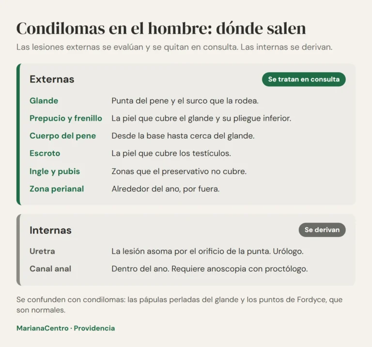 Diagrama de dónde salen los condilomas en el hombre: lesiones externas en glande, prepucio, cuerpo del pene, escroto, ingle y zona perianal, y lesiones internas en uretra y canal anal que se derivan